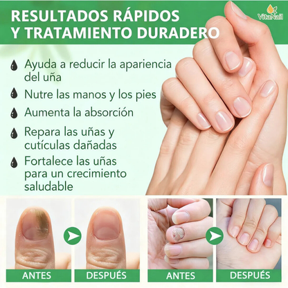 VITANAIL | TRATAMIENTO ANTI HONGOS 7 DÍAS 100% NATURAL