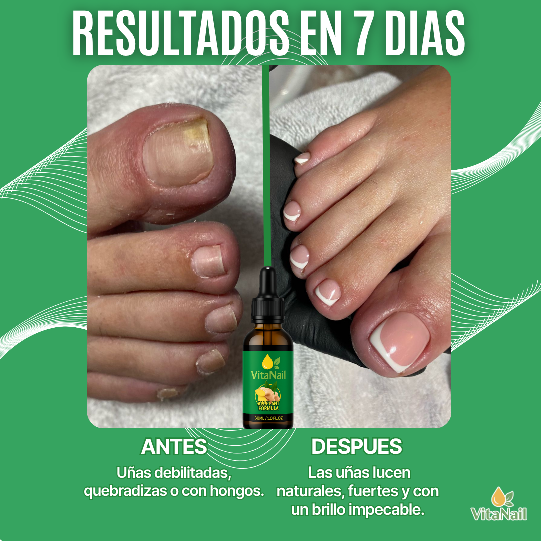 VITANAIL | TRATAMIENTO ANTI HONGOS 7 DÍAS 100% NATURAL