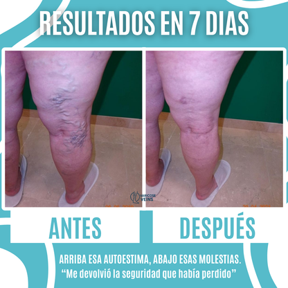 VARICOSE VEINS | TRATAMIENTO PARA VARICES 2x1 – RESULTADOS EN 7 DIAS