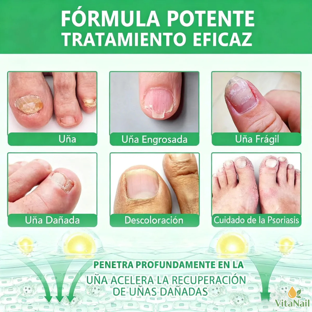 VITANAIL | TRATAMIENTO ANTI HONGOS 7 DÍAS 100% NATURAL