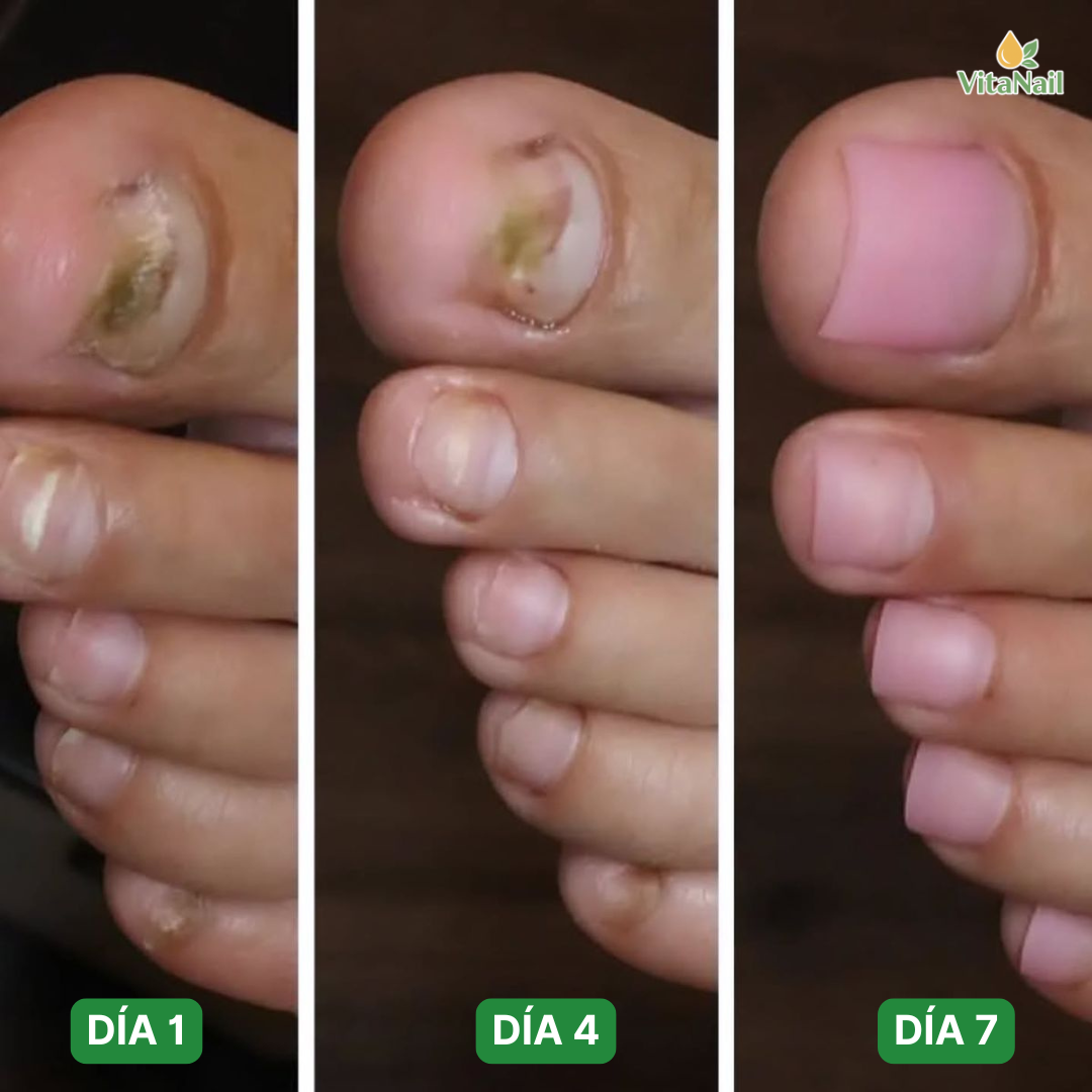 VITANAIL | TRATAMIENTO ANTI HONGOS 7 DÍAS 100% NATURAL