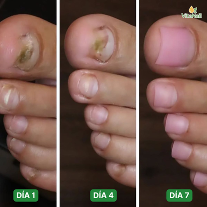 VITANAIL | TRATAMIENTO ANTI HONGOS 7 DÍAS 100% NATURAL