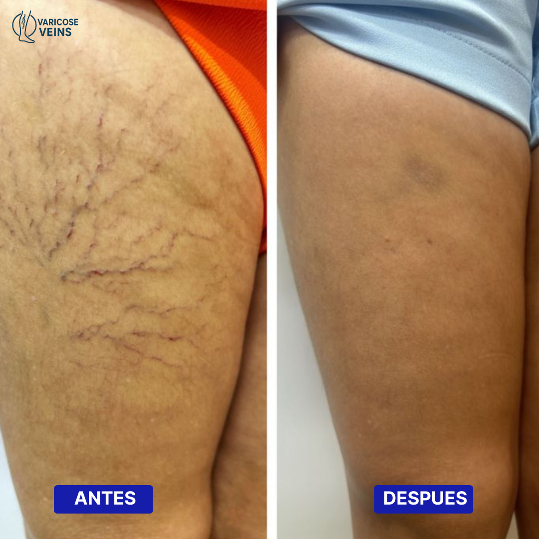 VARICOSE VEINS | TRATAMIENTO PARA VARICES 2x1 – RESULTADOS EN 7 DIAS