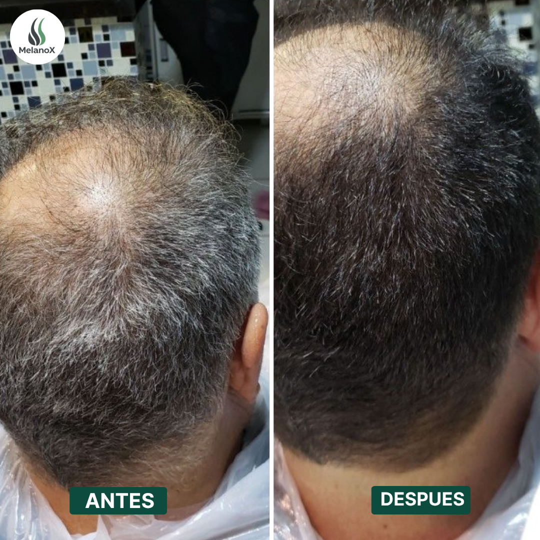 MELANOX | SHAMPOO ANTICANAS + 2 REGALOS EXCLUSIVOS