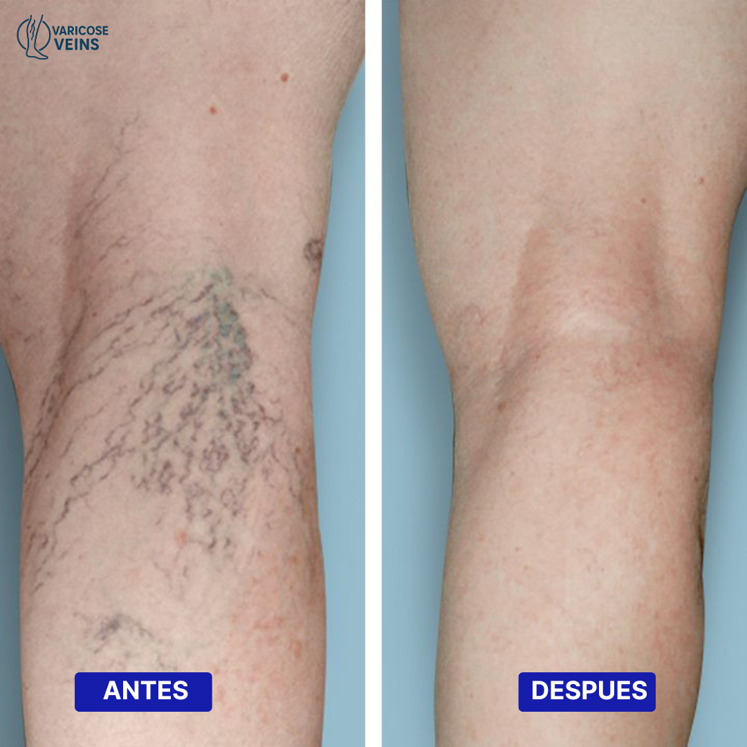 VARICOSE VEINS | TRATAMIENTO PARA VARICES 2x1 – RESULTADOS EN 7 DIAS